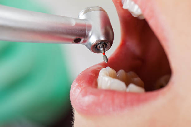 Best Knocked-Out Tooth (Avulsed Tooth) Treatment in Mount Carroll, IL